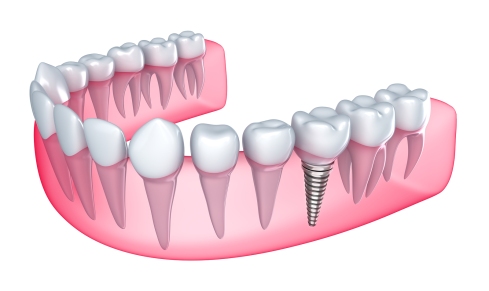 Dental-implants-tooth-replacement-treatment